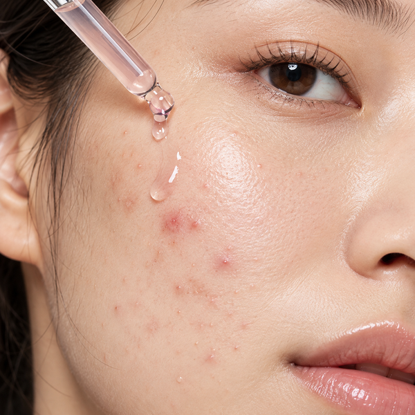 Acne & Texture